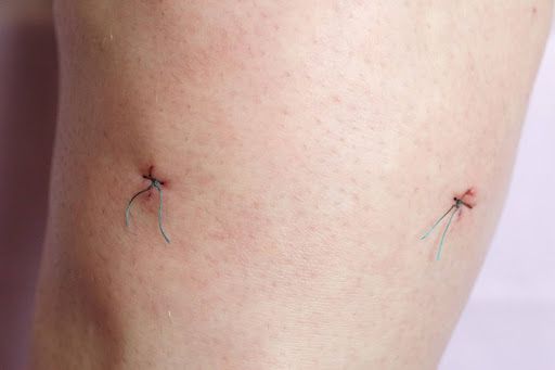 Arthroscopic Meniscectomy