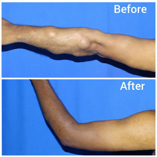 Clinical photo of a lipoma — soft fatty lump under skin