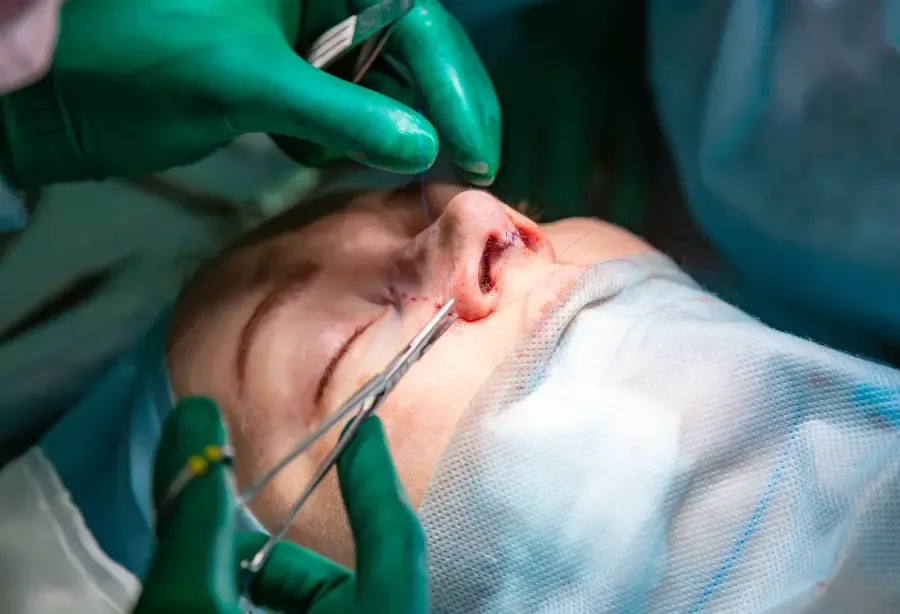 Open Rhinoplasty