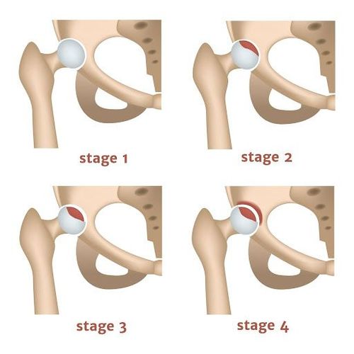 best-osteoarthritis-of-the-hip-treatment-surgery-symptoms-causes